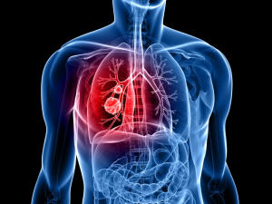 Cancer du poumon
